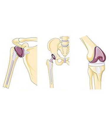 Colorectal Reconstructive Surgery