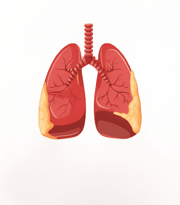 Invasive Lobular Carcinoma (ILC)
