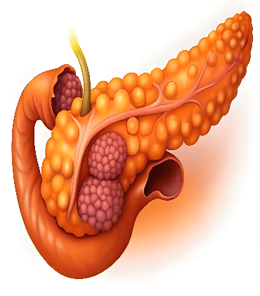 Invasive Lobular Carcinoma (ILC)