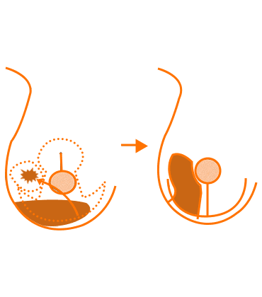 Therapeutic Mammoplasty