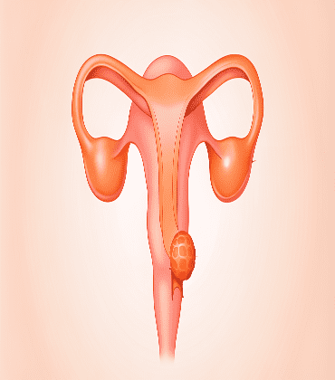 Invasive Lobular Carcinoma (ILC)