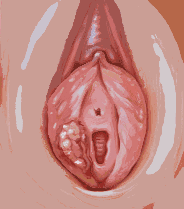 Invasive Lobular Carcinoma (ILC)