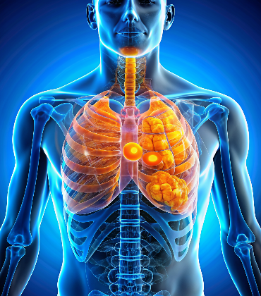 Invasive Lobular Carcinoma (ILC)