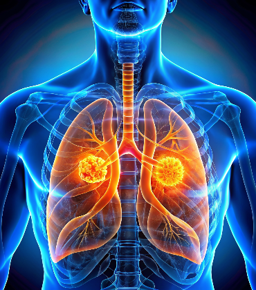 Ductal Carcinoma In Situ (DCIS)