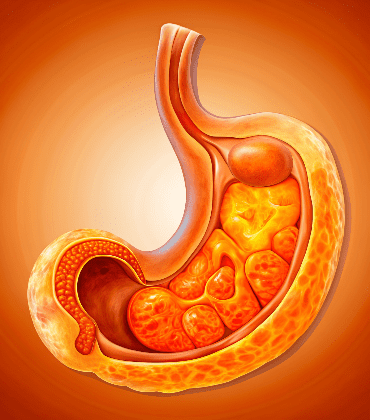 Invasive Ductal Carcinoma (IDC)
